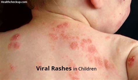 Viral Rashes In Children Causes Symptoms And Prevention