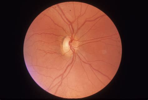 Leber Optic Atrophy Hereditary Ocular Diseases