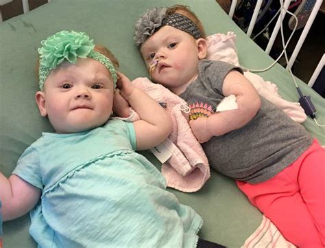 Taking A Look At The Miraculous Conjoined Twins Years Later