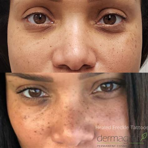 Cosmetic Freckle Tattooing Get The Look Today Dermagrafix