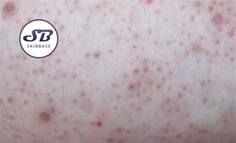 How To Improve The Appearance Of Keratosis Pilaris Using Free Download Nude Photo Gallery