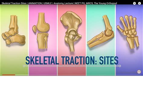 Skeletal Traction Sites —