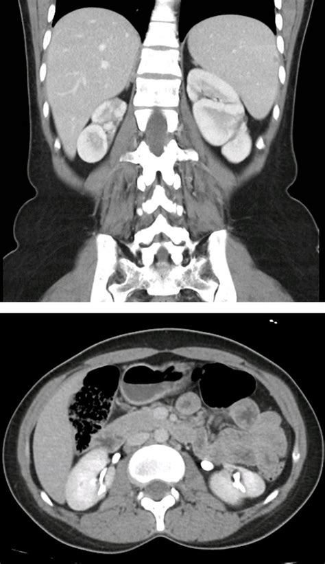 Persistent Fetal Lobulation Of Kidney Mimicking Renal Tumour Bmj Case