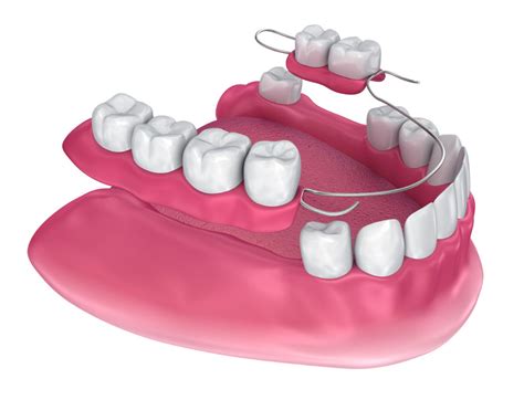Removable Denture - Star Bright Dental