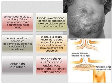 Hernias Pared Abdominal Anterolateral Y Lumbar