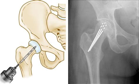 Avascular Necrosis Avn Of The Femoral Head — Andrew Dold Md