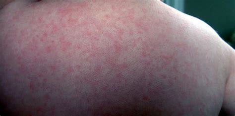 Roseola Rash Pictures Symptoms Causes Treatment Home Remedies
