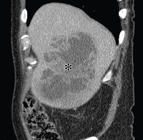 Us Of Right Upper Quadrant Pain In The Emergency Department Diagnosing