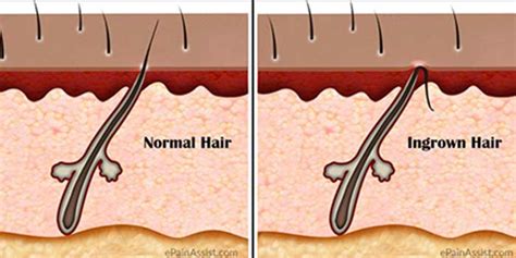 Ingrown Hair On Head Scalp Pictures Symptoms Removal