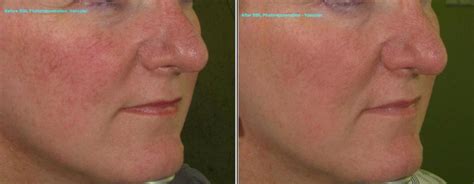 Photorejuvenation Ipl Vascular Before And After Gallery