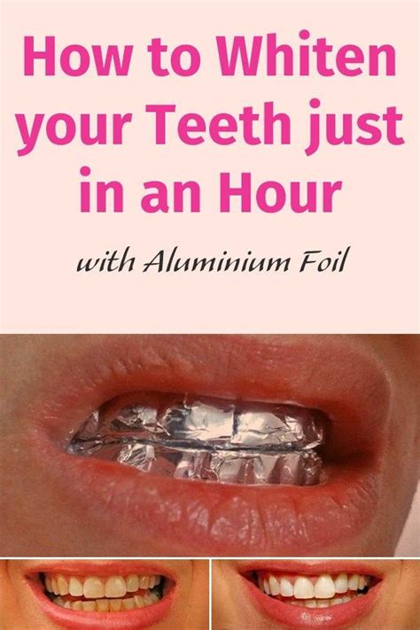 Teeth whitening with braces is one of the main concerns of people wearing braces and carring about how beautiful their smile is. How to Whiten your Teeth just in an Hour with Aluminium ...