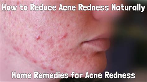 How To Reduce Acne Redness Naturally Home Remedies For Acne Redness