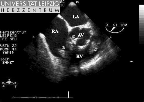Right Ventricular Outflow Tract
