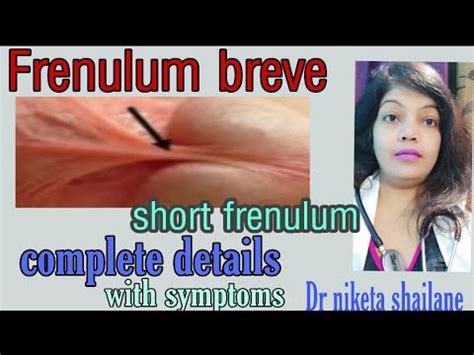 What Is Frenulum Breve Short Frenulum Complete Details With Symptoms