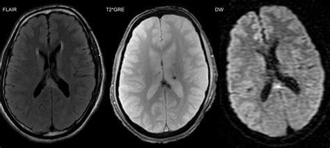 Image Of Diffuse Axonal Damage On Magnetic Resonance Vinmec