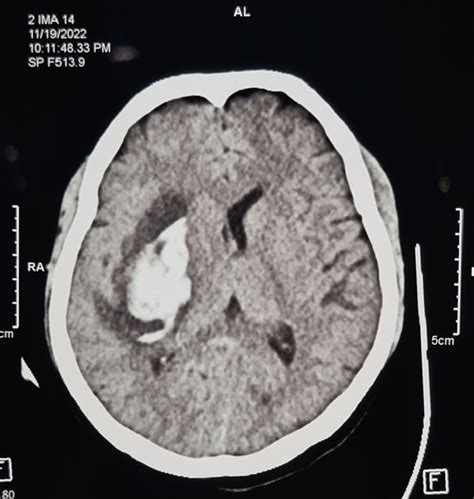 Noncontrast Computed Tomography Head Showing Intracerebral Haemorrhage