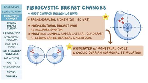 Benign Breast Conditions Pathology Review Osmosis