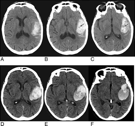 The Ct Swirl Sign Is Associated With Hematoma Expansion In