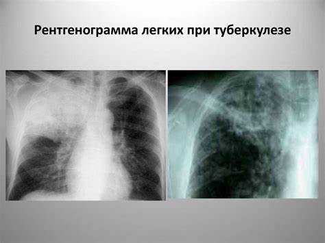 Снимок Легких При Туберкулезе Фото — Картинки фотографии Картинка - Снимок Легких При Туберкулезе Фото — Картинки фотографии