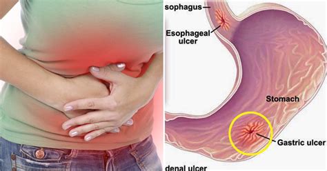 This is the case unless the cancer is a lymphoma. These 5 symptoms of gastritis can cause you to develop ...