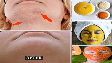 how to remove facial hair naturally at home permanently facial hair removal youtube