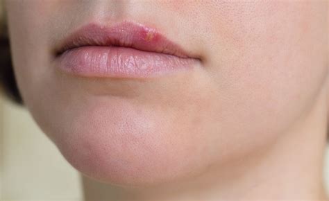 What Causes Cold Sores How To Treat And Prevent Cold Sores