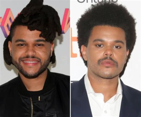 The Weeknd Before And After Plastic Surgery Journey Vanity