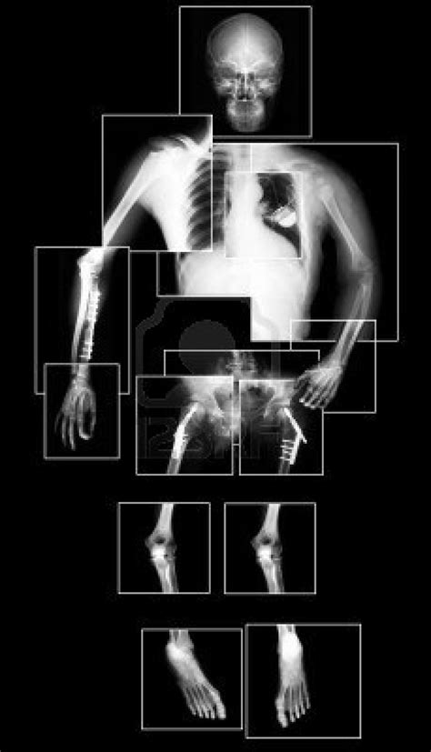 17 Best Images About X Ray Photos On Pinterest X Rays