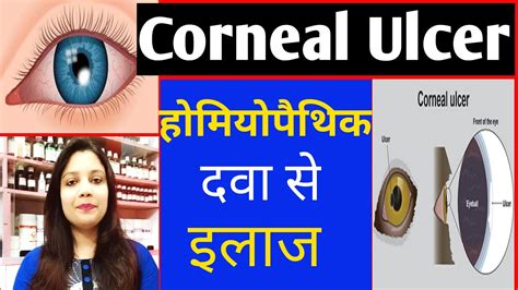 Corneal Ulcer Causes Symptoms And Homeopathic Treatment For Corneal