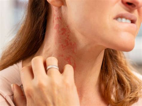 8 types of itchy rash images