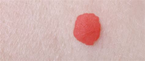 Cherry Angiomas Red Spots Causes And Treatment — Moyal Therapies