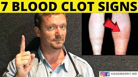 7 Warning Signs Of A Blood Clot Symptoms 2022 Youtube