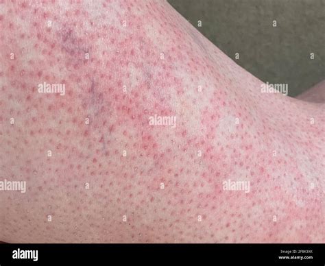 Mottled Skin Heat Rash Hives Allergy Reaction On Knee Close Up