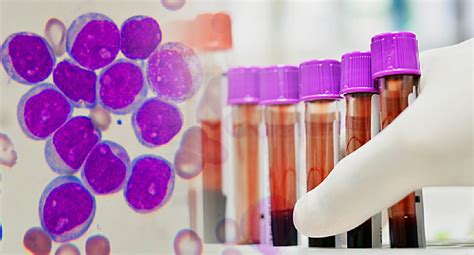 The treatment of cancer and leukaemia is a developing area of medicine. Chronic Myelogenous Leukemia (CML): Causes, Symptoms ...