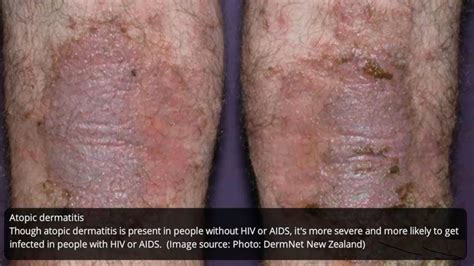 If a patient presents with fever and mild symptoms suspicious for early hantavirus infection within 6. What does HIV rash looks like? - STD Testing Near Me