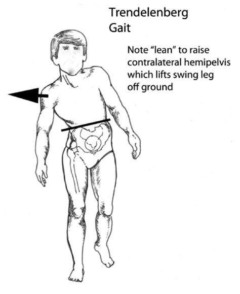 With this type, a these may cause them to limp or walk differently but are not considered causes of abnormal gait. The Analysis of a Limp Walking requires a symphony of ...