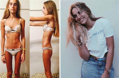 Teenager Who Weighed 55st During Anorexia Battle Shares Her Recovery