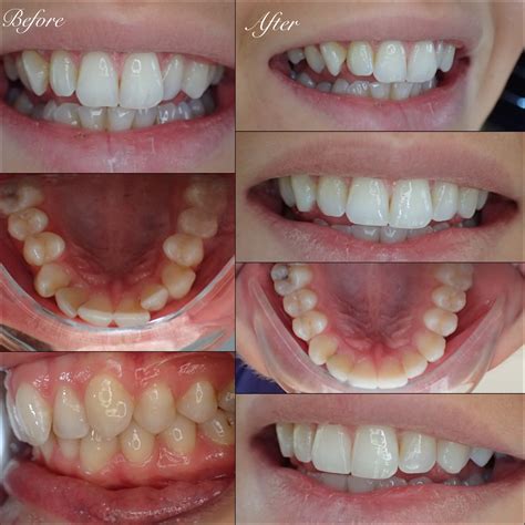 Adult Braces The Whyte House Dental Practice Exeter