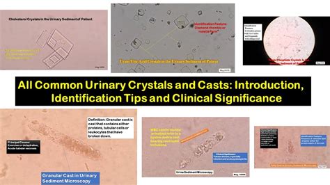 All Common Crystals And Casts Of Urine Introduction Identification And