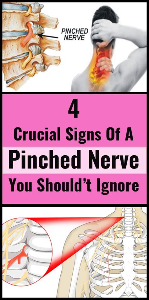 4 Crucial Signs Of A Pinched Nerve You Really Should’t Ignore Pinched Nerve Nerve Problems Nerve