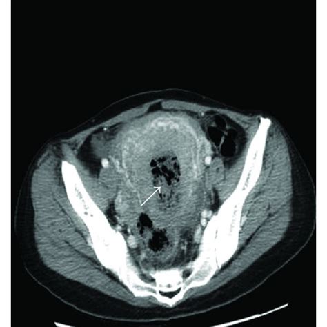 A Tan Fungating Necrotic Tumor In The Anterior Uterine Wall Arrow