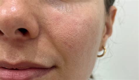 Large Pores Treatment Adelaide Advanced Cosmetic Medicine