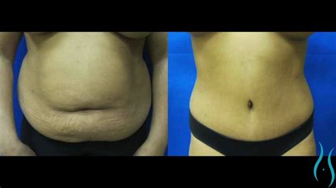 Tummy Tuck Before And After Photos In Connecticut Youtube