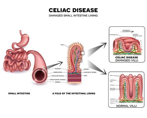 Celiac Disease Damage 600×482 Celiac Celiac Disease Disease
