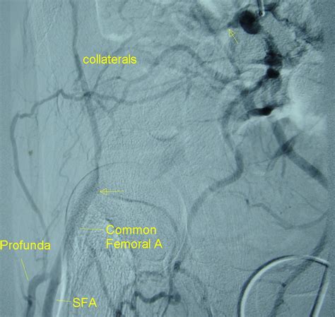 External Iliac Artery Occlusion Seen On A Digital Subtraction Angiogram