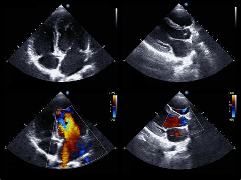 Ecocardiograma Mostra Veia Entupida