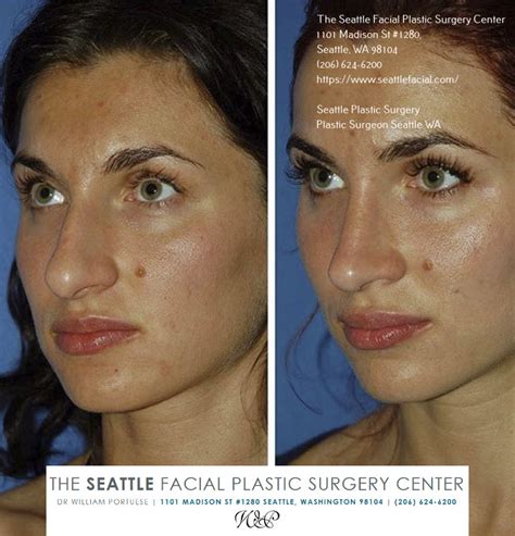 Rhinoplasty In Seattle WA