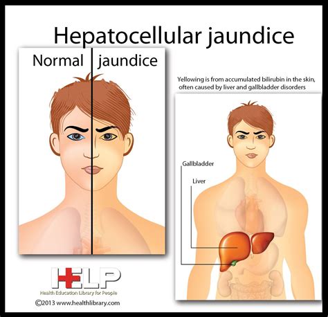Diagnosis: Jaundice Nursing Diagnosis