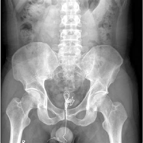 Kidney Ureter Bladder Abdominal Radiography A Tangled Wire In The