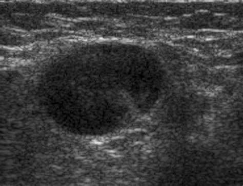 Sonographic Features Of Axillary Lymphadenopathy Caused By Kikuchi
